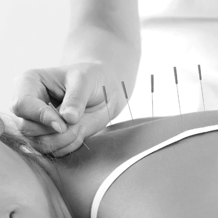 Acupuncture is being done on a female's back